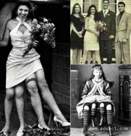 世界上腿最多的女人,4條腿照樣結婚生子