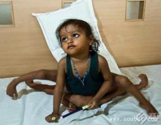 世界上腿最多的女人,4條腿照樣結婚生子