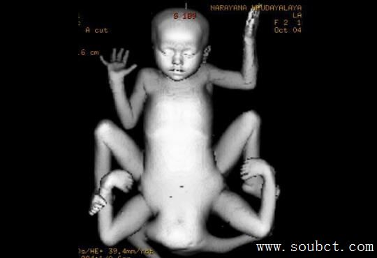 世界上腿最多的女人,4條腿照樣結婚生子