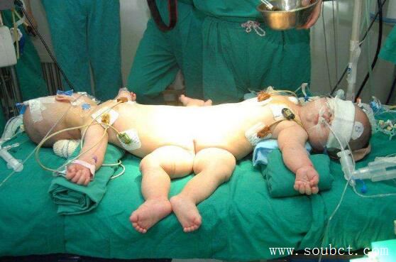 世界上腿最多的女人,4條腿照樣結婚生子