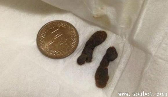 世界上最大的耳屎居然有硬幣大