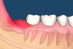 智齒是什么,一種應該拔掉的牙齒