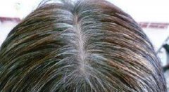 少白頭除了遺傳原因,精神壓力大也會(huì)一夜白頭