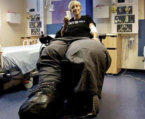 世界上腿最粗的女人,腿比上半身還重