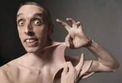 世界上皮膚最有彈性的人，能將皮膚拽出15.8厘米