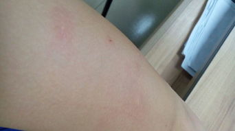 被臭蟲咬了怎么辦