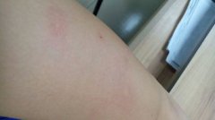 被臭蟲咬了怎么辦