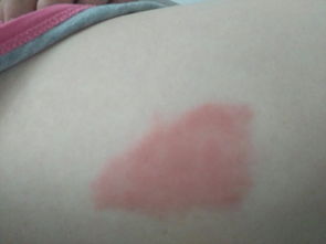 飛蟻咬人后怎么辦