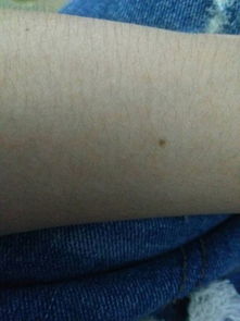 臉上有蒼蠅屎怎么去除