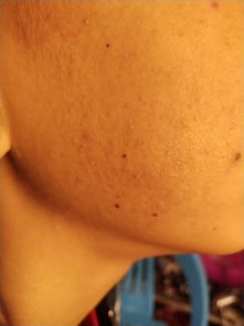 臉上有蒼蠅屎怎么去除