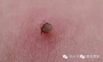 怎么分辨蜱蟲頭是否留在皮膚里