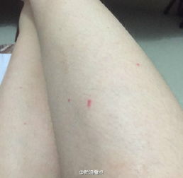 怎么分辨蜱蟲頭是否留在皮膚里