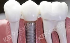 瑞士種植牙多少錢(qián)