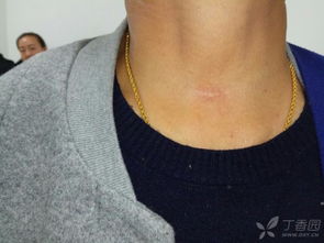 朱迅甲狀腺全切了嗎