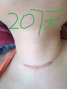 朱迅甲狀腺全切了嗎