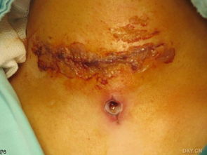 朱迅甲狀腺全切了嗎