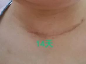 朱迅甲狀腺全切了嗎