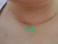 朱迅甲狀腺全切了嗎