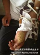 虎頭蜂蜇人怎么處理