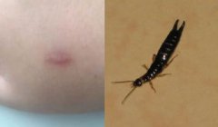 被蠼螋咬了有什么反應