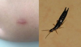 被蠼螋咬了有什么反應