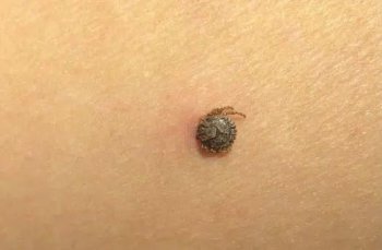 被蜱蟲咬了怎么辦