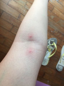 手被毒蟲咬了怎么辦