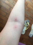 手被毒蟲咬了怎么辦