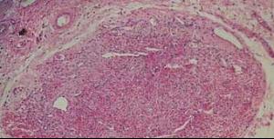 膚蠅蛆中國有嗎