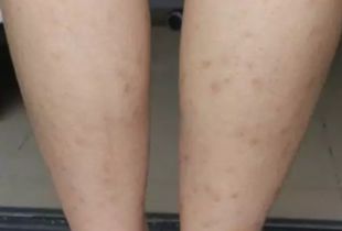 張碧晨腿上有紋身嗎