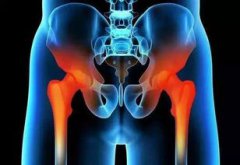 劉歡換的是哪種髖關節