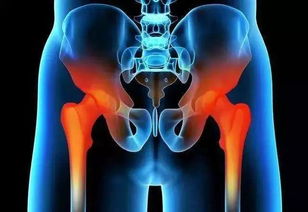 劉歡換的是哪種髖關節