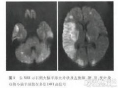 什么是多發(fā)性腦梗死