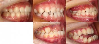 兒童地包天什么時(shí)候矯正