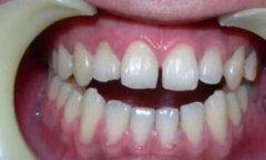 地包天如何矯正