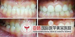 地包天會遺傳嗎