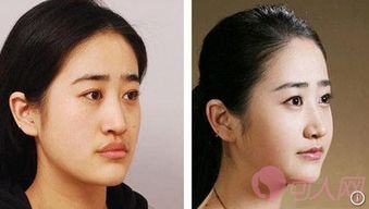 地包天手術(shù)風(fēng)險大嗎