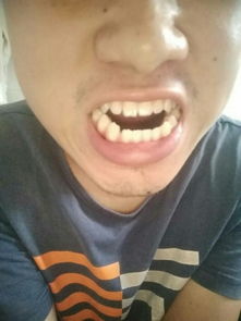 彭于晏牙齒是地包天嗎