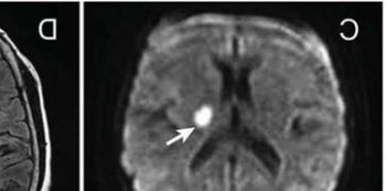 小腦梗死一般多久能好