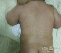 濕疹為什么要用硼酸