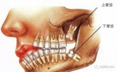 為什么一定要拔智齒