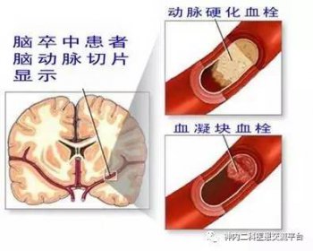 腦梗和腦梗死的區(qū)別是什么