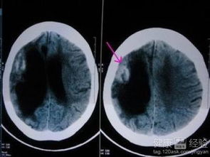 腦梗死是怎么回事