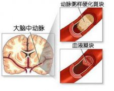 腦梗塞和腦梗死一樣嗎