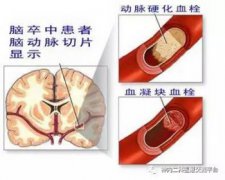 腦梗死與腦梗塞什么區(qū)別