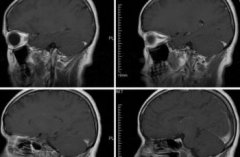 腦梗死的原因是什么