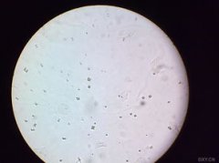 草酸鈣結晶偏高的原因是什么