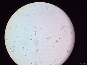 草酸鈣結晶偏高的原因是什么