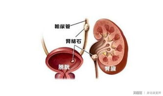 草酸鈣結(jié)石是怎么形成的