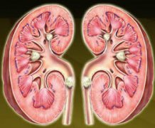 草酸鈣結石怎么溶解